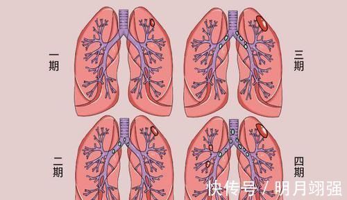 癌细胞|肿瘤专家说癌症是人体“内乱”，轻易别开刀和做筛查，有道理吗？