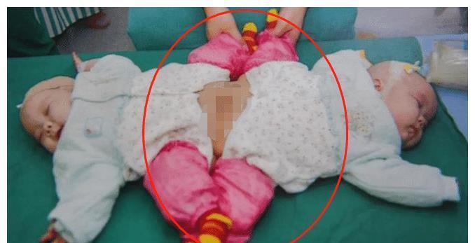 父母|还记得我国首例“坐骨连体”双胞胎女婴吗?多年后,她们化茧成蝶