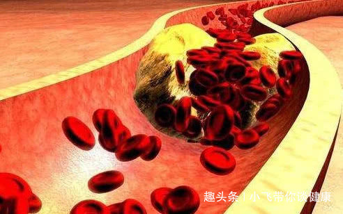 黑色食物|它是天然“阿司匹林”!早晚吃两口,血管干净,血栓悄悄“溜走”