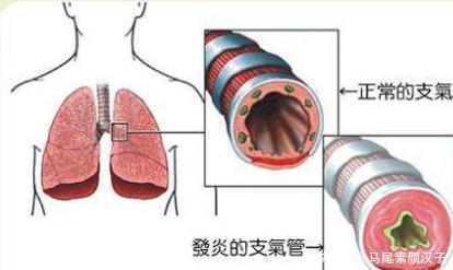 什么是急性支气管炎小儿多见如何治疗 快资讯