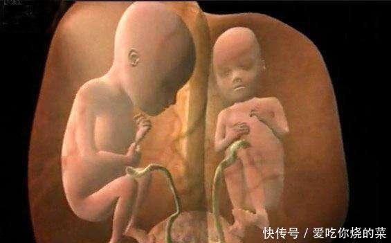 唇裂|30岁孕妇怀双胎查出唇腭裂，不舍得打掉，看到宝宝全家乐开花！
