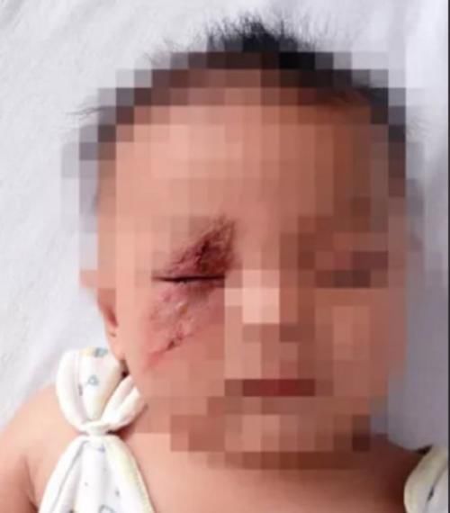 妈妈|两个月婴儿全身溃烂有脓,妈妈称家里不关窗,被“毒虫”趁虚而入