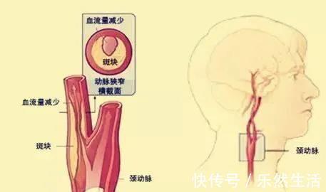 缺血性中风|颈动脉斑块一定会导致脑中风吗？一文带你读懂