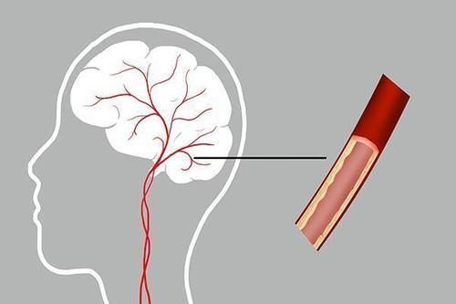 动脉|颈动脉狭窄，应该怎么办？放支架，还是继续吃药？医生说清楚