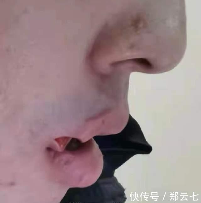 cb严惩任骏飞！李原宇被肘击嘴角恐怖撕裂，裂口超长去医院缝了12针