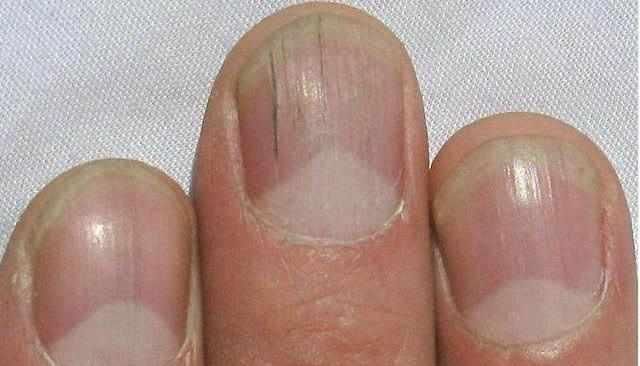 手掌|无论男女,如果手上没有这3个“特征”,恭喜你,肝脏还很健康