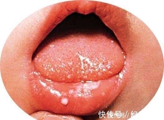 便秘|心火过旺的5个表现,多吃4种食物,不失眠、不便秘、睡得香