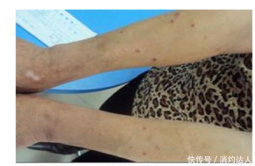 甲床下纤维瘤|我从出生身上皮肤就有颜色不一的情况是结节硬化症问题么?