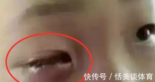 毯子|20分钟男孩眼珠被“熔化”，家长们都该敲响警钟，家庭安全别大意