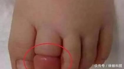 脚趾|4岁孩子脚趾肿的厉害,妈妈不放心带去医院,医生幸好来得早