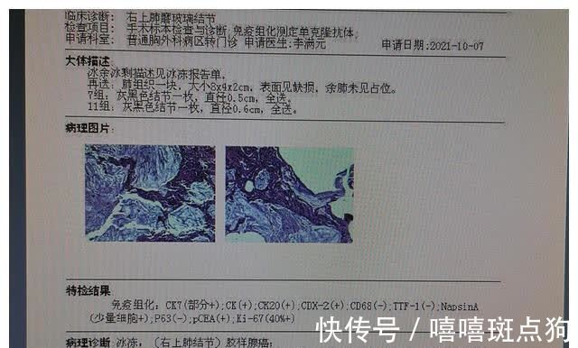 结节|磨玻璃肺癌都是高分化腺癌吗？磨玻璃结节发展到哪种腺癌都有可能