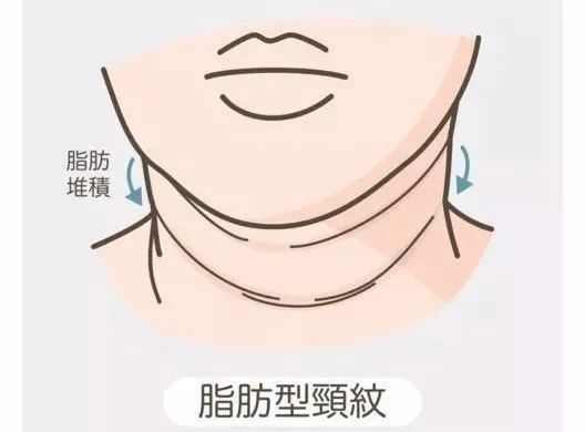 折纹|你的脖子比脸更显老,出现颈纹该怎么去除?丨科普篇