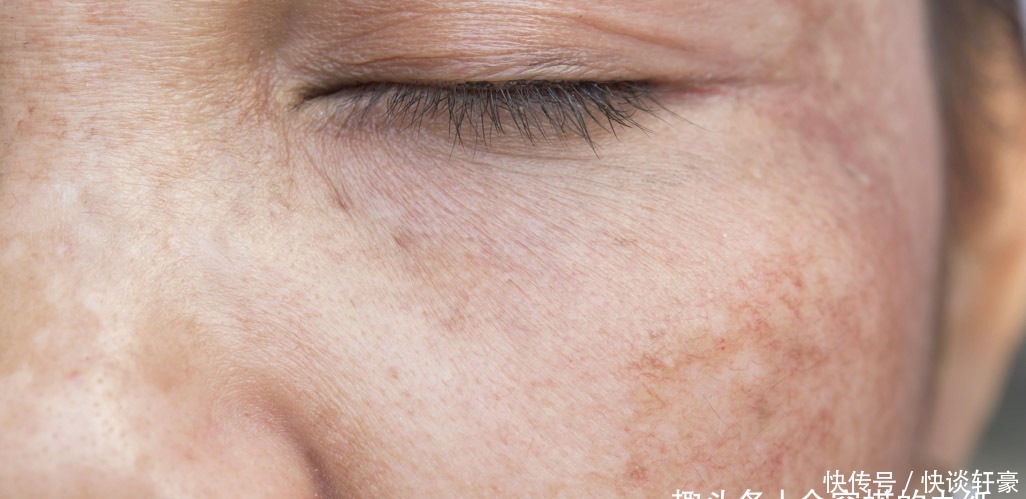 激光|困扰大多数人的色斑,到底用什么办法才能去除?