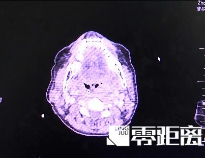 王女士|感冒喉咙痛可以吃冰棒缓解?医生给出适用范围!