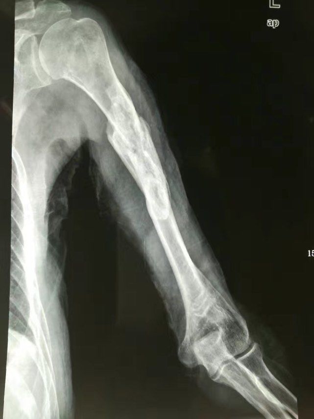 手腕|当心！掰手腕也能导致骨折