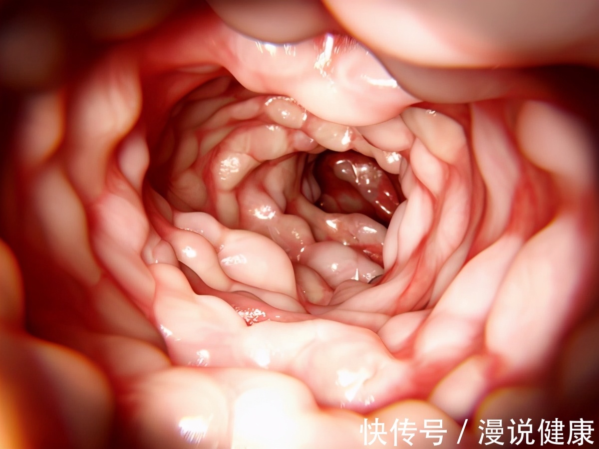 红肉|全球新增肠癌193万例?肠癌的4个祸首,希望在生活中都能记住