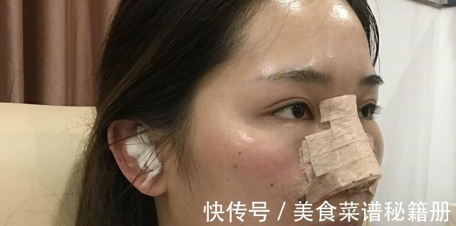 自然风格 隆鼻术后假体穿透鼻尖,这也太吓人了!