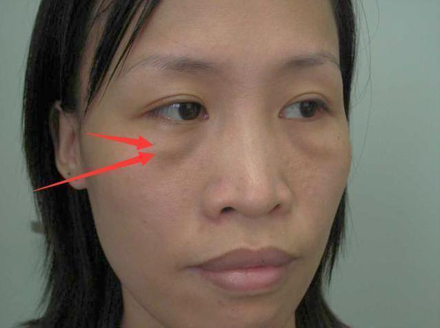 女人长眼袋细纹别慌，每天抹点厨房常见物品，抚平眼袋细纹显年轻