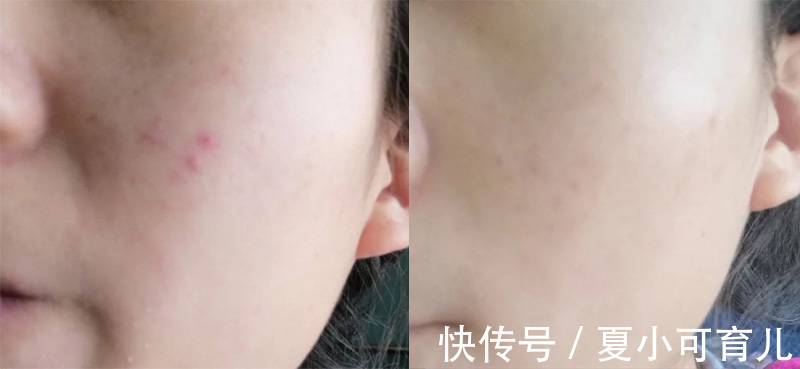 肌肤 已被拉入“黑名单”的护肤品,皮肤科医生都不敢用,孕妈还在囤?