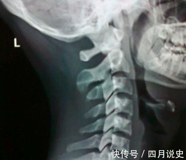 mri|下肢无力,肌肉跳动,走路像踩棉花?可能是颈椎脊髓压迫症