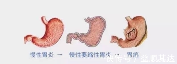 胃病|不想“胃炎”变“胃癌”3大胃病“克星”，养护脾胃更健康