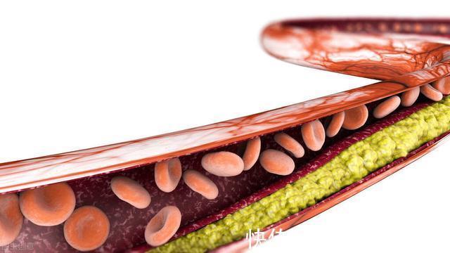 高血脂|血脂高的人,哪些食物应该少吃?要注意控制饮食,才能少生病!