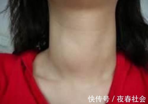 冬瓜|甲状腺结节的“克星”找到了，经常吃，化瘀散结，结节悄悄变小！