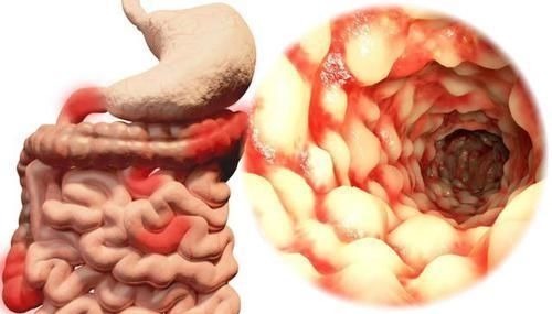 癌肿|排便不畅,是肠癌吗?医生:符合3个标准,尽早去医院检查一下