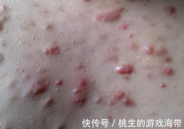 吸烟|注意：皮肤有三个异常表现，尽早查查肺