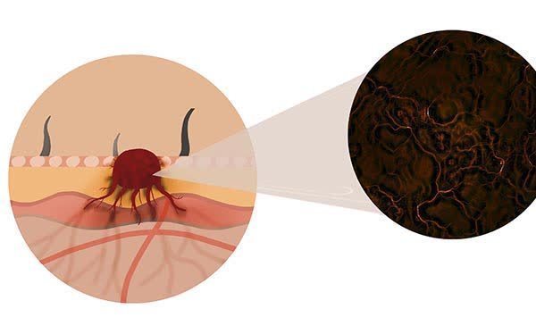 治好|癌症患者成功度过了5年生存期，是不是就治好了？下面该做什么？