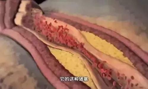 胆固醇|血管堵塞最致命！教你一招快速疏通，血管通了，一身轻松