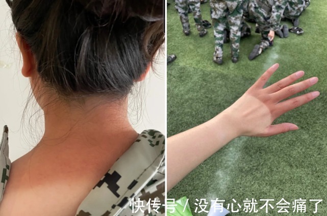 皮肤|军训晒黑了怎么办?军训后如何做好晒后修复及补水?