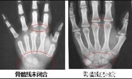 骨骼|男孩长高有2个“黄金期”，骨骼线闭合前都有机会，别放弃太早