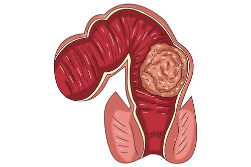 致命的粗心“把直肠癌当成痔疮”，医生：4个区别要分清楚