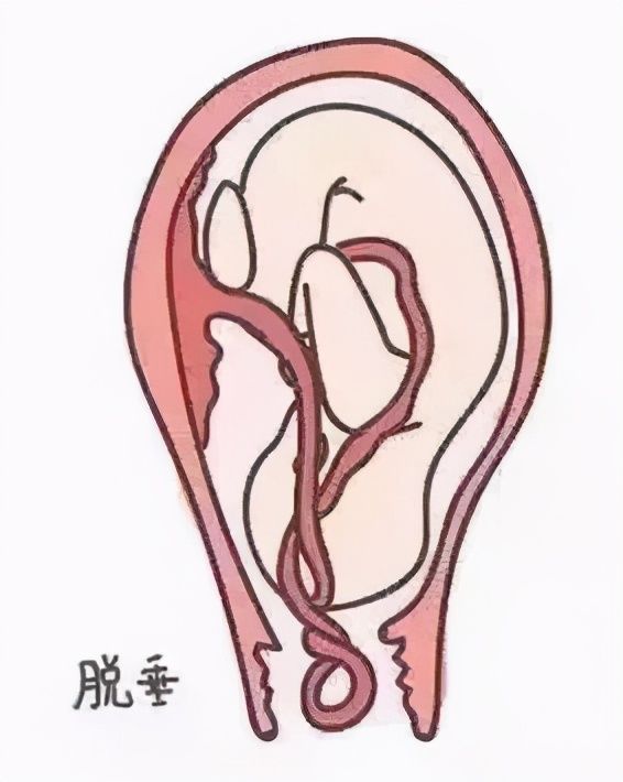 阴道|胎儿脐带脱垂命悬一线,医护协力争分夺秒,助准妈妈4分钟平安分娩
