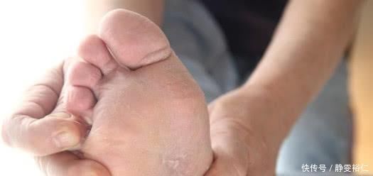 “尿毒症”来临前,手脚发出的小信号,要引起重视了