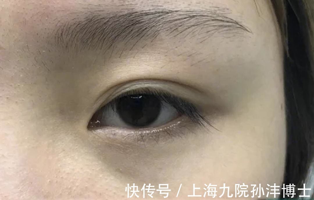 双眼皮 眼修复孙沣博士:双眼皮术后出现分叉能修复吗?