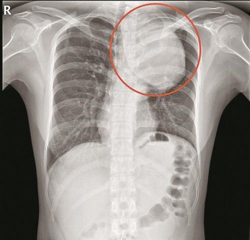 主动脉瘤|险！主动脉里长出青芒大的瘤