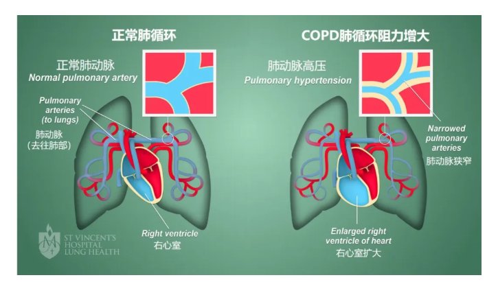 心衰|【健哥说心脏】多年慢阻肺，心脏也喊累