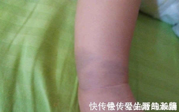 小孩|奇闻!小孩身上的印记竟是这个,原以为是被打的,结果意外