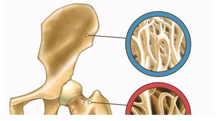 补钙|骨质疏松不能吃甜食？骨科医生：2物多吃，跟骨质疏松说“再见”