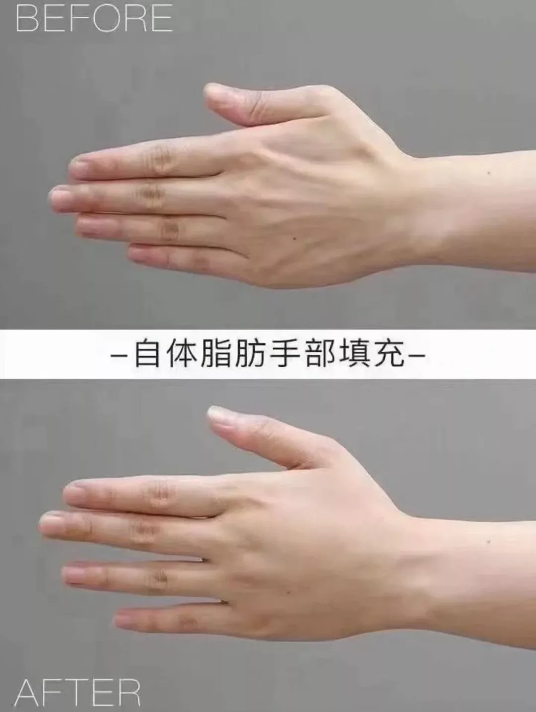 手术|又一个被“自残式整容”手术毁掉的中国女孩,好可怕...