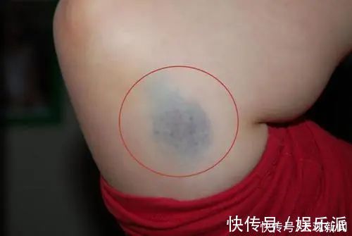 淤青|没磕没碰，为何身上总有淤青？或许与这些原因有关系，别忽视