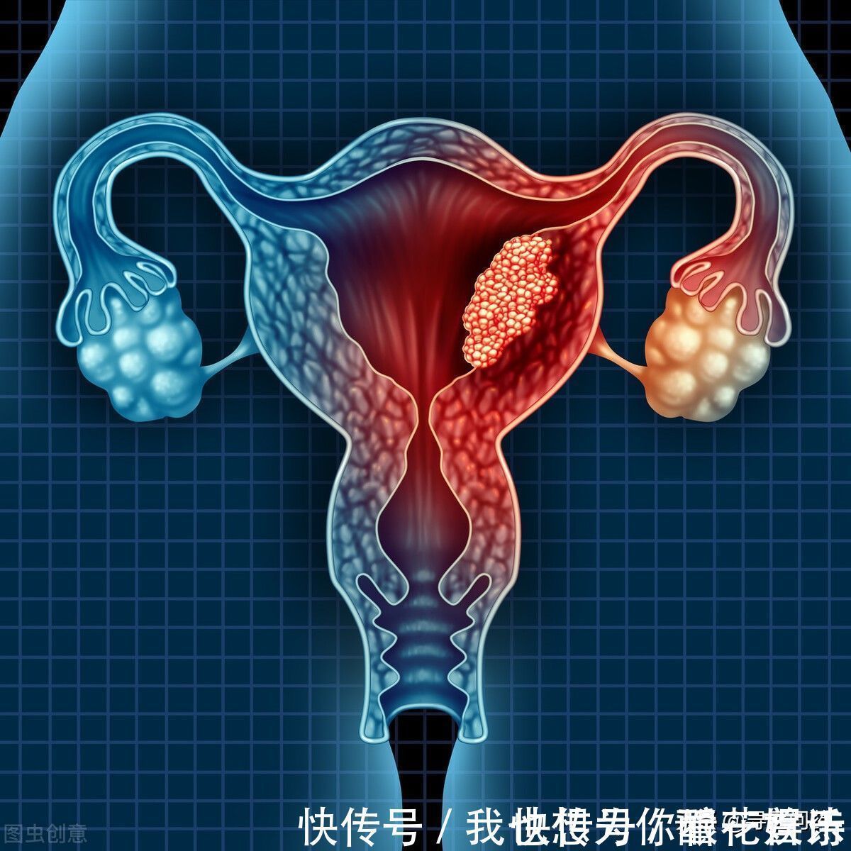 家族史|53岁的李老太还没绝经,以为自己老来春,结果是癌