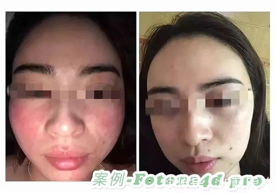 医美 你是敏感肌吗？敏感肌适合做什么医美项目？ 如何做好日常护理？