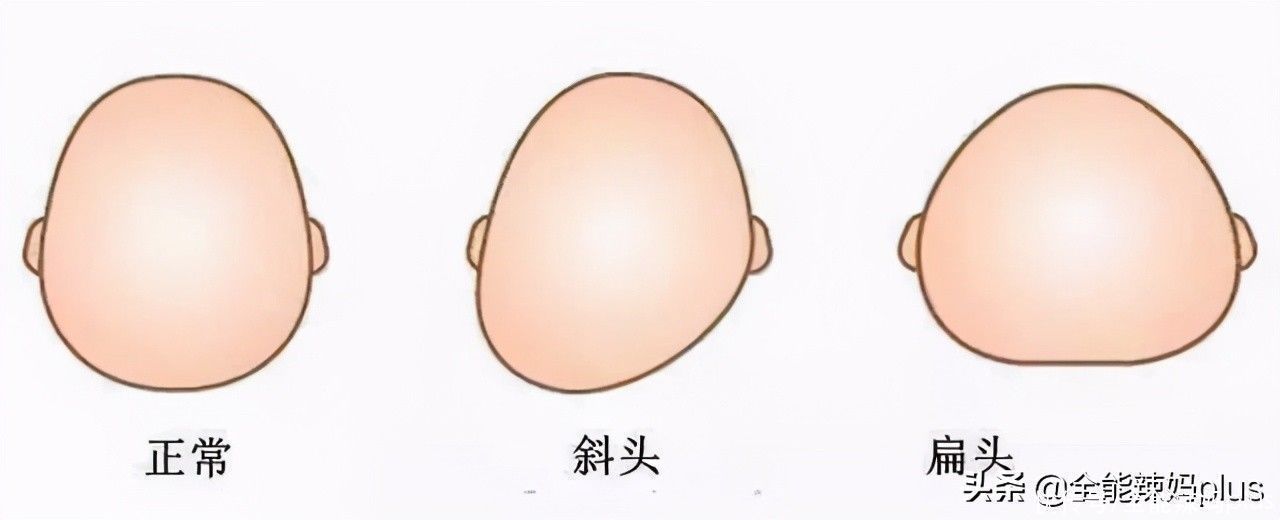 孩子|“妈求求你,别给我睡扁头了”扁头有多毁娃?3张对比图告诉你