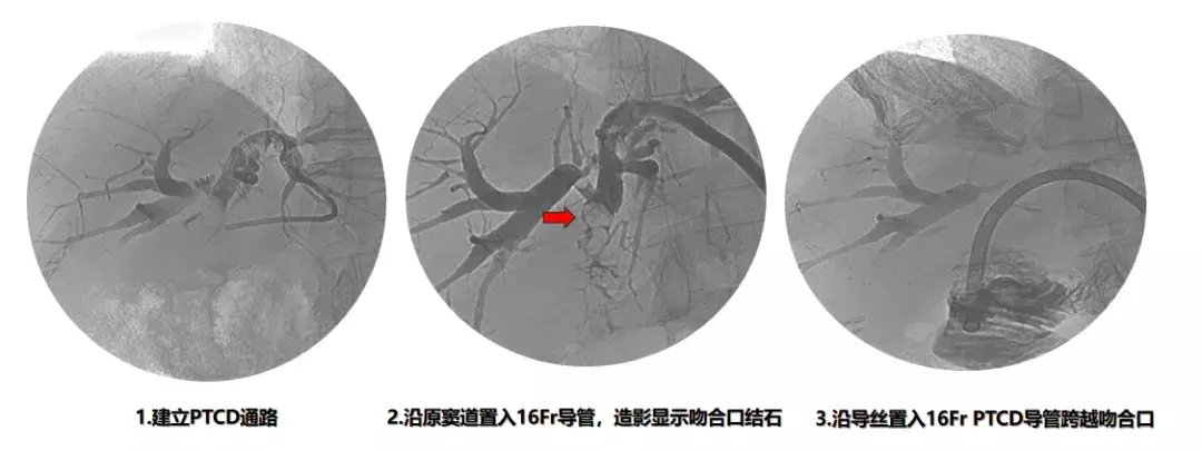 引流管|新型微创取石术破解复杂性胆管结石难题