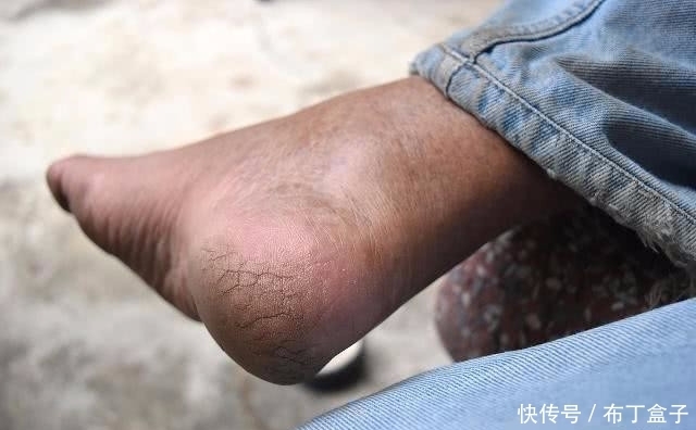 现干裂的情况|入冬后,脚后跟“干裂”?可能与3个“原因”有关