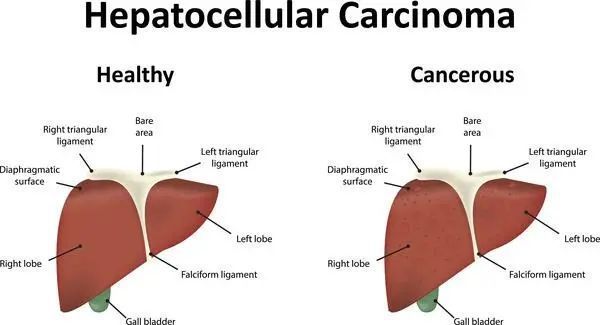 生存期|一旦确诊肝癌，究竟还能活多久？医生坦白：关键要看这3点