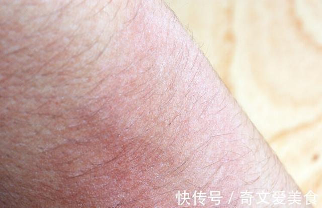 皮炎|湿疹、皮炎,擦什么好得快?常见皮肤病“用药指南”,一看就会